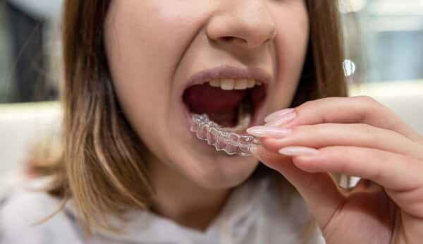 Do You Have To Wear A Retainer After Clear Aligners?