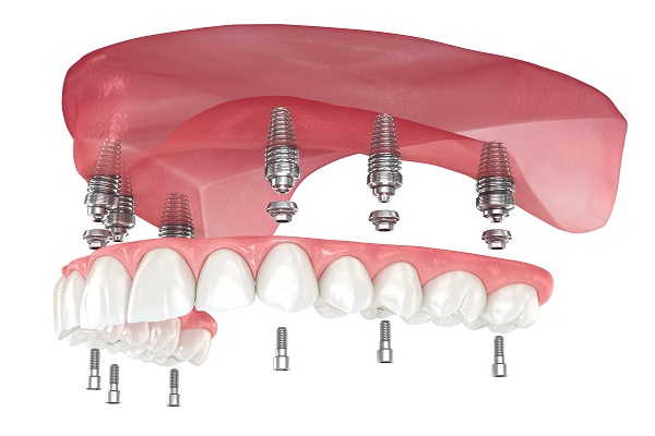 Why Choose Implant Supported Dentures?