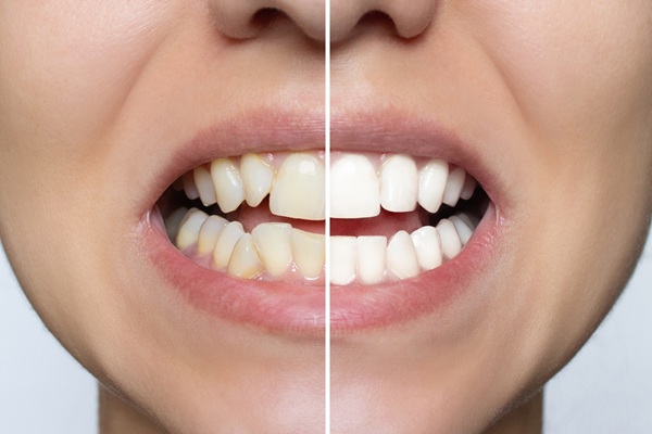 How Teeth Whitening Targets Discoloration And Stain